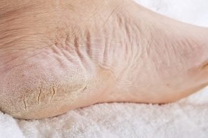 Pentingnya Menjaga Kesehatan Kaki: Ketahui Penyebab Kulit Pecah-Pecah