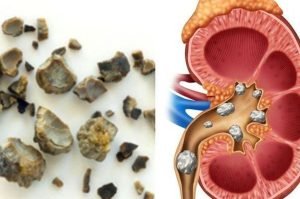 Atasi Batu Ginjal Secara Alami dengan 11 Ramuan Rumahan